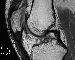Patella Tendon Rupture MRI Post Repair